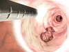 Ung thư giai đoạn sớm thường “rất ngoan”, bác sĩ Bạch Mai chỉ cách phát hiện và ngăn chặn kịp thời