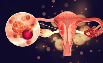 Chứng rối loạn phổ biến ở phụ nữ có thể dẫn đến ung thư buồng trứng