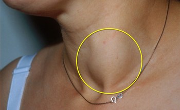 Dấu hiệu nhận biết loại ung thư tuyến giáp thường gặp ở phụ nữ 30 - 50 tuổi