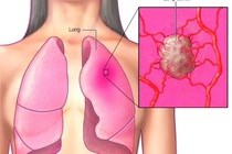 Các triệu chứng thường gặp của ung thư phổi ở nữ giới