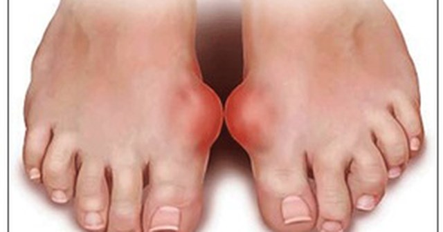 Bệnh gout là một tình trạng viêm của khớp gây ra bởi sự tăng acid uric trong máu.